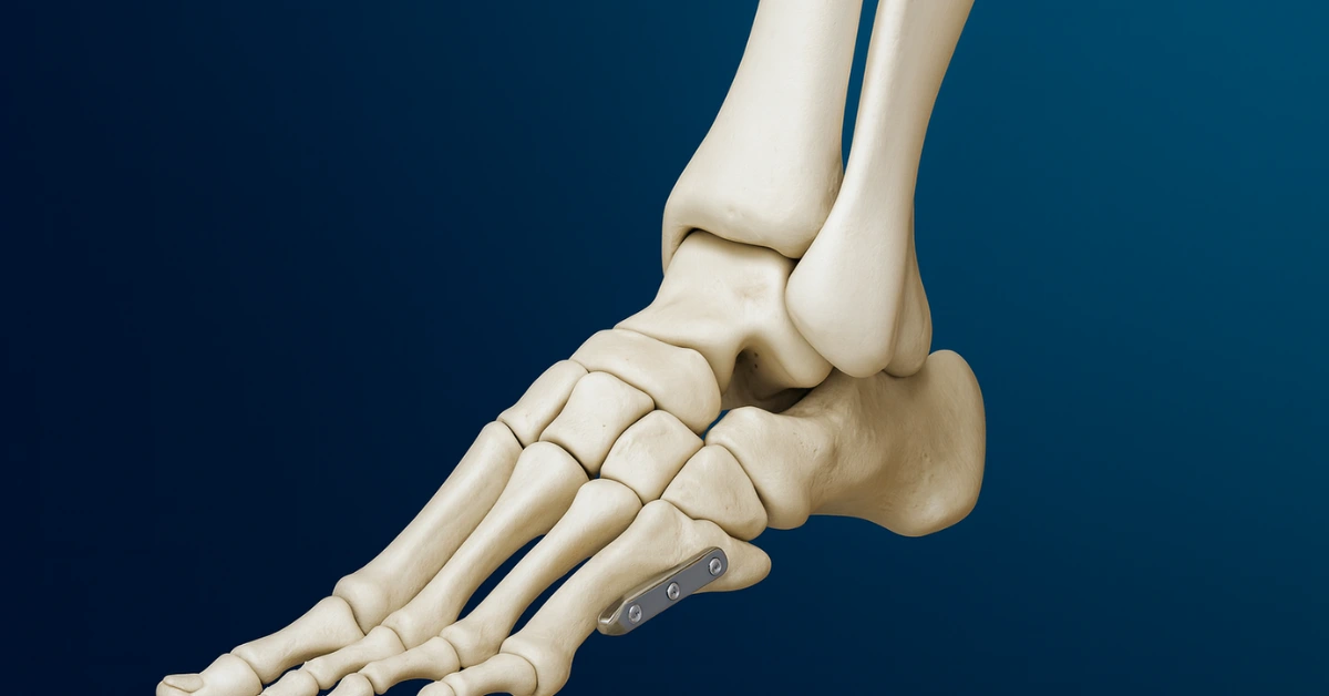 Jones Fracture – Fixation
