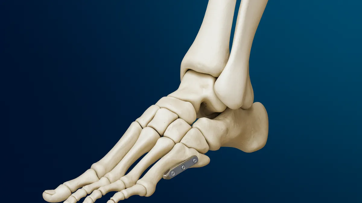 Jones Fracture Fixation
