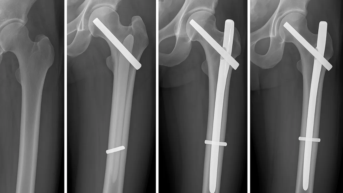 PFN Fixation of Trochanteric Fracture