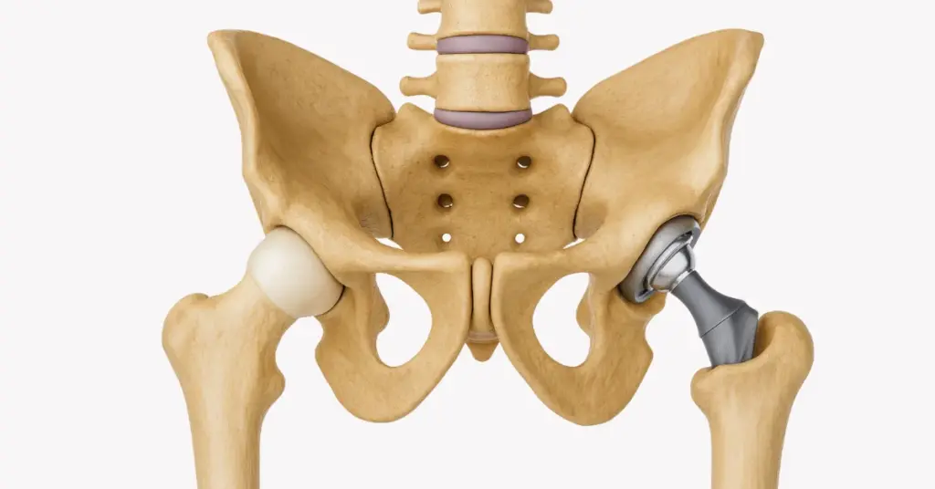 Hip Replacement