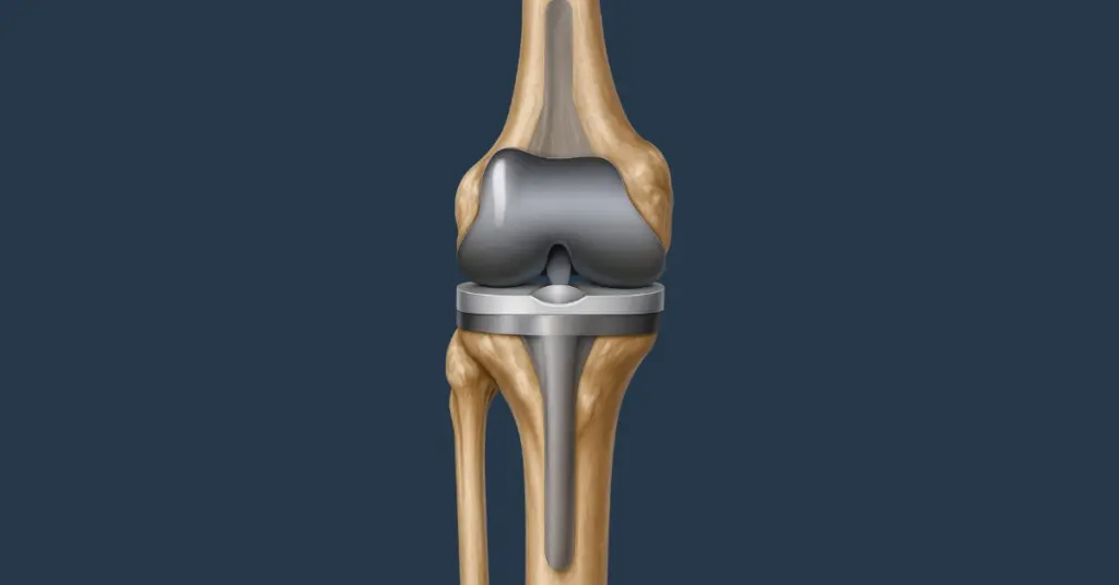Knee Replacement