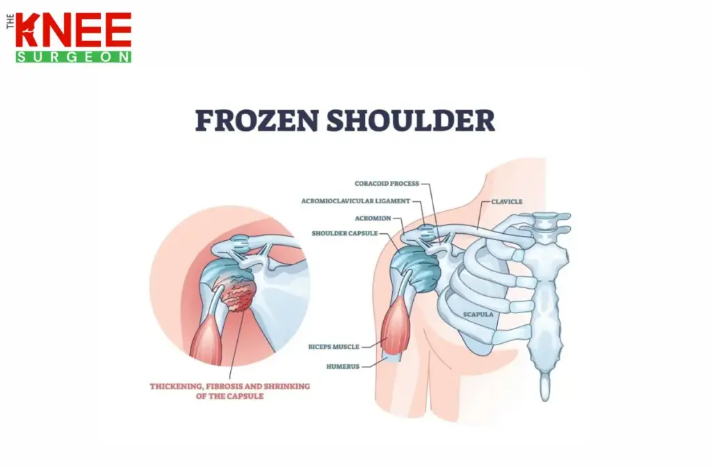 Frozen Shoulder Treatment 1 Frozen Shoulder Treatment