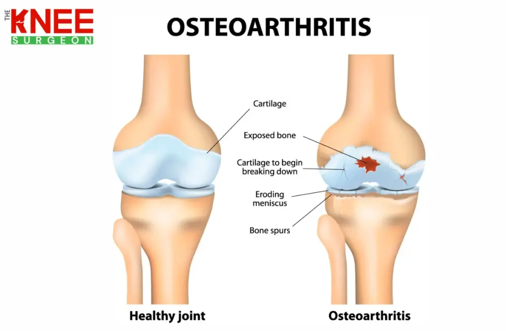 Knee Cartilage Damage